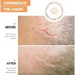 Strataderm Gel for the Treatment of Abnormal Scars, 20 g, Meditrina Pharmaceuticals