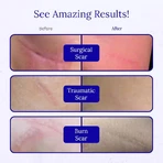 RejuvaSil-siliconen-gel, 30 ml, Scar Heal