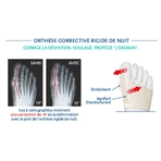 Epitact-Orthese für die Nachtkorrektur des Hallux valgus x1